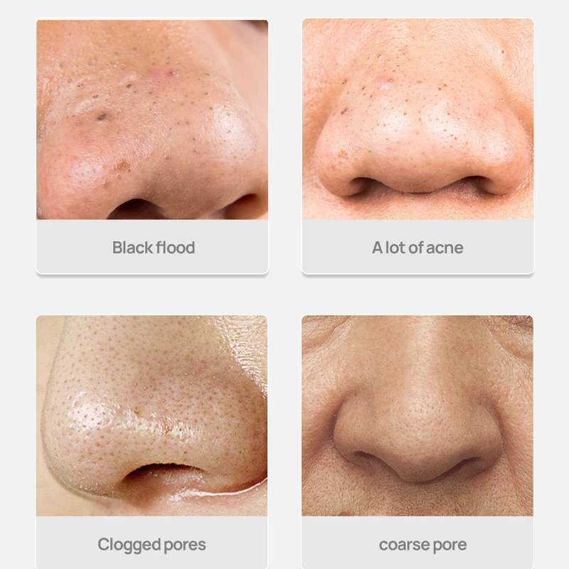Маска за носа Контрол масла за Премахване на пъпки Отшелушивающее Дълбоко почистване Стесняване на порите на Възстановяване на увредените тъкани на кожата Грижа за лицето-30 г3